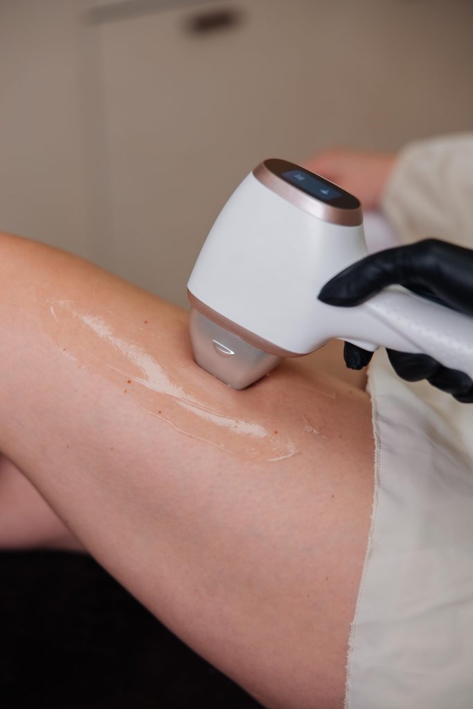 Bovenbeen laserbehandeling